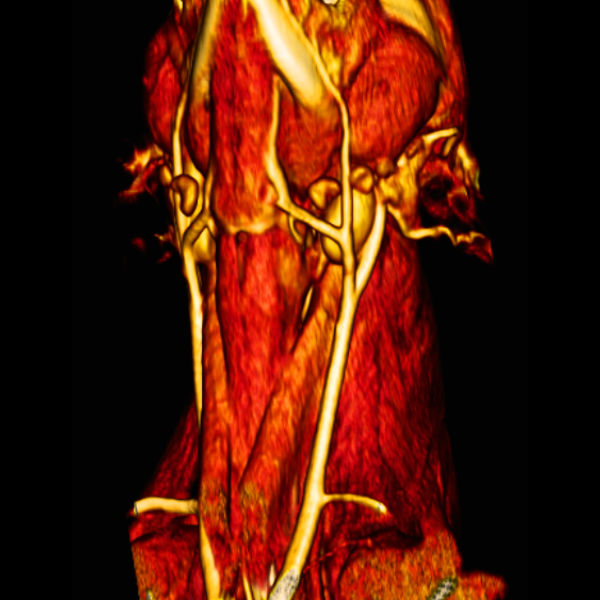 Alterações Vasculares por Tomografia Computadorizada